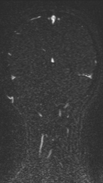 Normal MRI brain with MRV- teenager (Radiopaedia 49425-54553 Coronal MRV 187).jpg