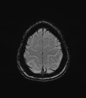 Normal brain MRI (TLE protocol) (Radiopaedia 40748-43405 Axial SWI 77).png
