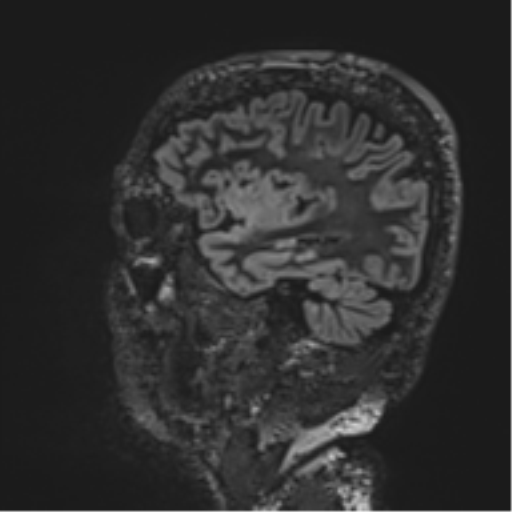 Normal brain MRI (non-focal epilepsy protocol) (Radiopaedia 53917-60040 Sagittal DIR 19).png