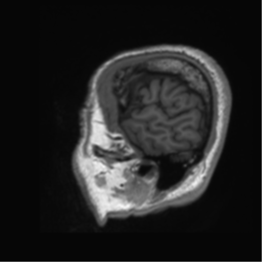 Normal brain MRI (non-focal epilepsy protocol) (Radiopaedia 53917-60040 Sagittal T1 1).png