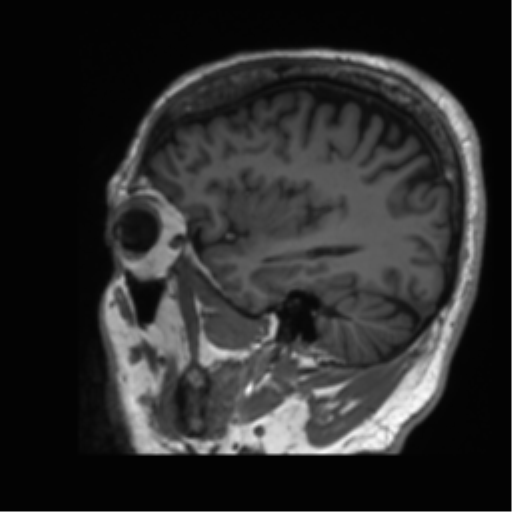 Normal brain MRI (non-focal epilepsy protocol) (Radiopaedia 53917-60040 Sagittal T1 14).png