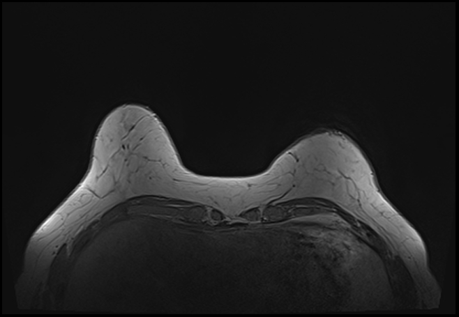 File:Normal breast MRI - dense breasts (Radiopaedia 80454-93850 Axial T1 41).jpg