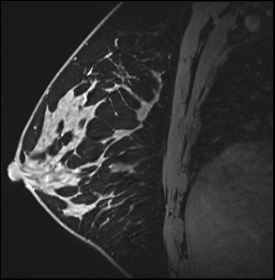Normal breast MRI - dense breasts (Radiopaedia 80454-93850 I 112).jpg