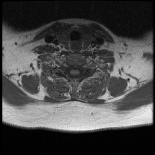 File:Normal cervical and thoracic spine MRI (Radiopaedia 35630-37156 Axial T1 10).png
