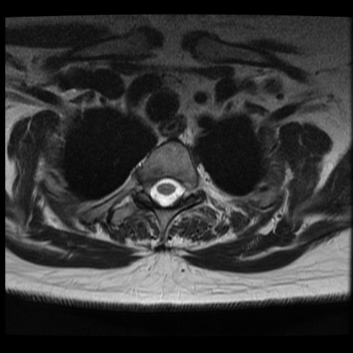 File:Normal cervical and thoracic spine MRI (Radiopaedia 35630-37156 Axial T2 3).png