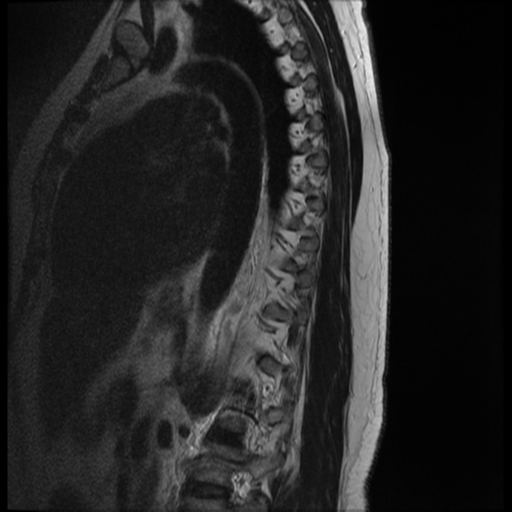 File:Normal cervical and thoracic spine MRI (Radiopaedia 35630-37156 G 1).png
