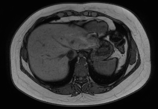 File:Normal liver MRI with Gadolinium (Radiopaedia 58913-66163 B 27).jpg