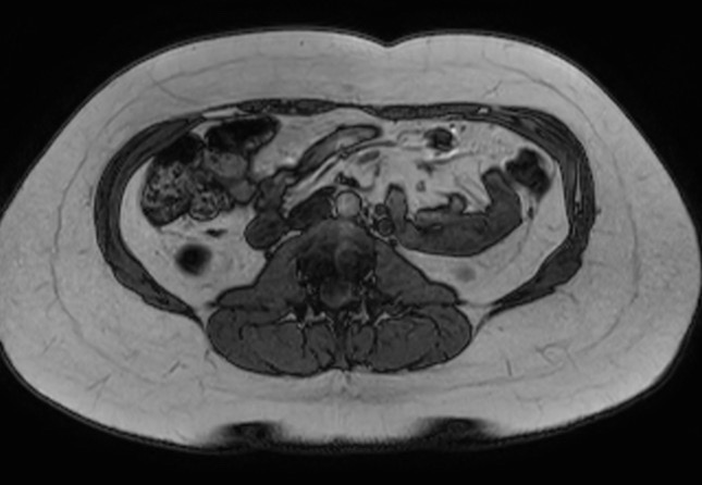 File:Normal liver MRI with Gadolinium (Radiopaedia 58913-66163 B 6).jpg
