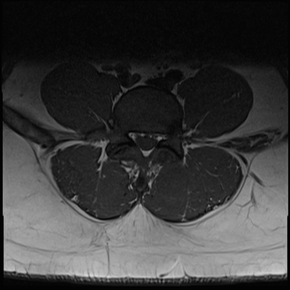 File:Normal lumbar spine MRI (Radiopaedia 47857-52609 Axial T1 20).jpg