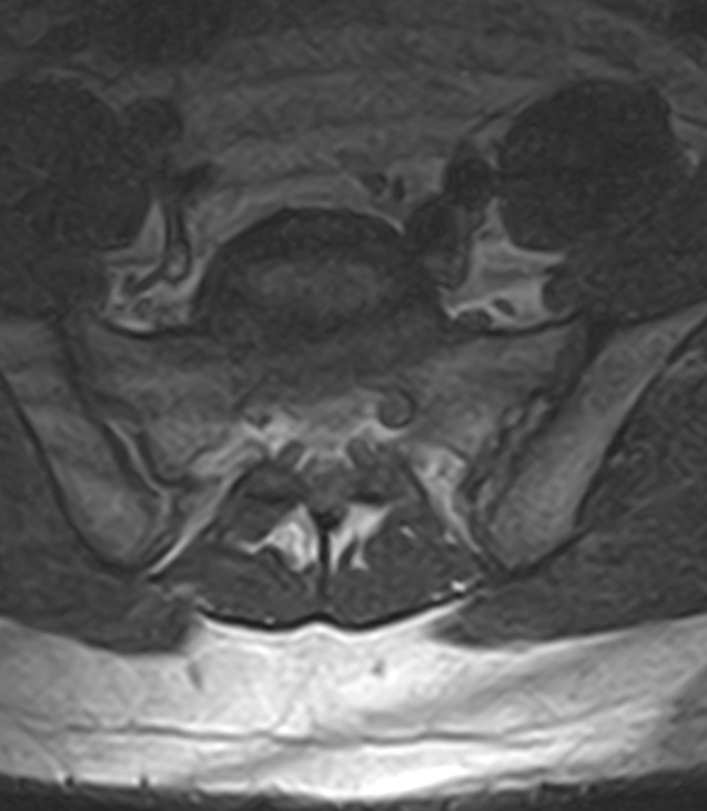 Normal lumbar spine MRI - low-field MRI scanner (Radiopaedia 40976-43699 Axial T2 92).jpg