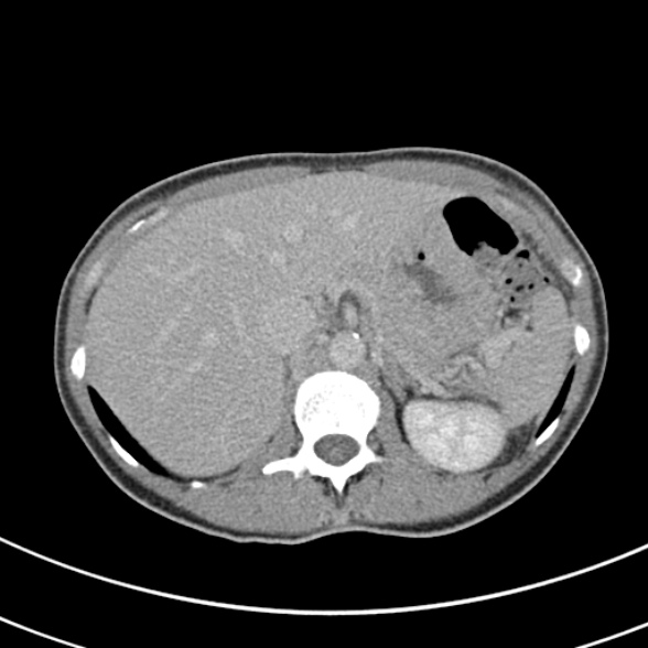 File:Normal multiphase CT liver (Radiopaedia 38026-39996 Axial C+ delayed 19).jpg