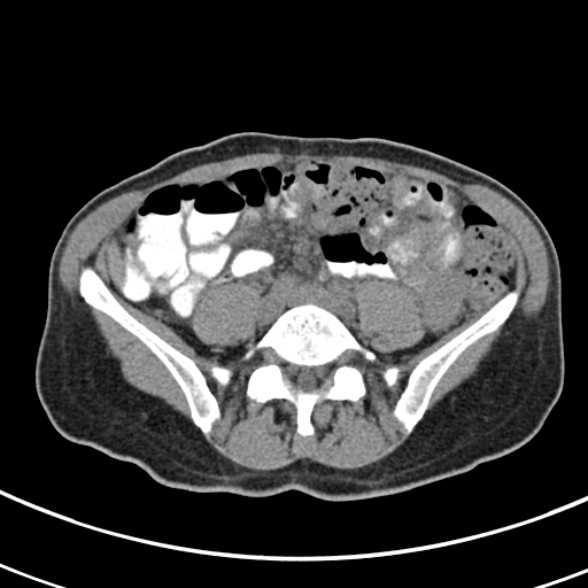 File:Normal multiphase CT liver (Radiopaedia 38026-39996 Axial non-contrast 57).jpg