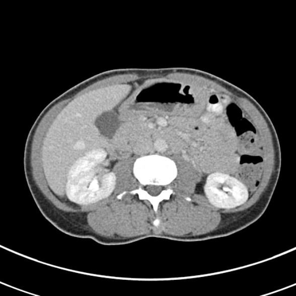 File:Normal multiphase CT liver (Radiopaedia 38026-39996 C 39).jpg
