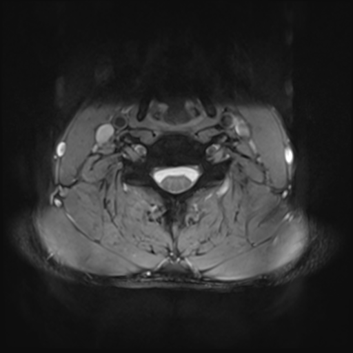 File:Normal trauma cervical spine (Radiopaedia 41017-43762 Axial T2 18).png