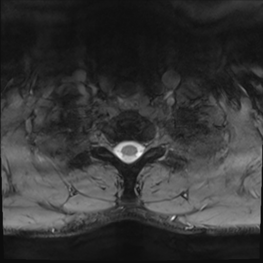 File:Normal trauma cervical spine (Radiopaedia 41017-43762 Axial T2 29).png