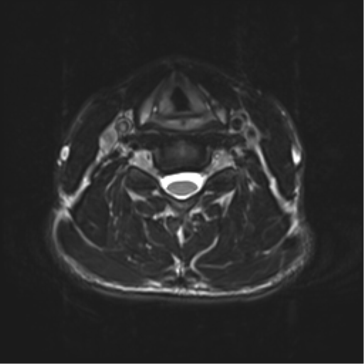 Normal trauma cervical spine (Radiopaedia 41017-43762 D 31).png