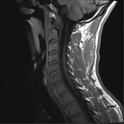 File:Normal trauma cervical spine (Radiopaedia 41017-43762 Sagittal T1 10).png