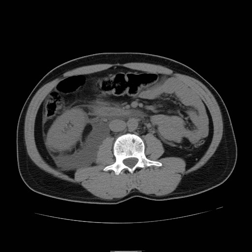 File:Obstructed kidney with perinephric urinoma (Radiopaedia 26889-27066 Axial non-contrast 28).jpg