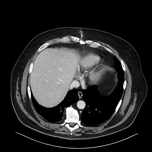 Obstructing sigmoid adenocarcinoma (Radiopaedia 58465-65619 A 22).jpg
