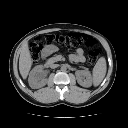 File:Obstructing ureteric calculus (Radiopaedia 18615-18514 Axial non-contrast 22).jpg