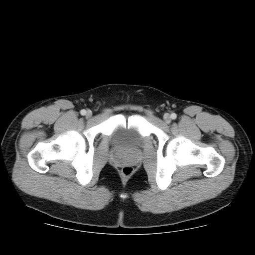 File:Obstructing ureteric calculus (Radiopaedia 18615-18514 B 56).jpg