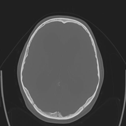 File:Obstructive hydrocephalus (Radiopaedia 30453-31119 Axial bone window 16).jpg