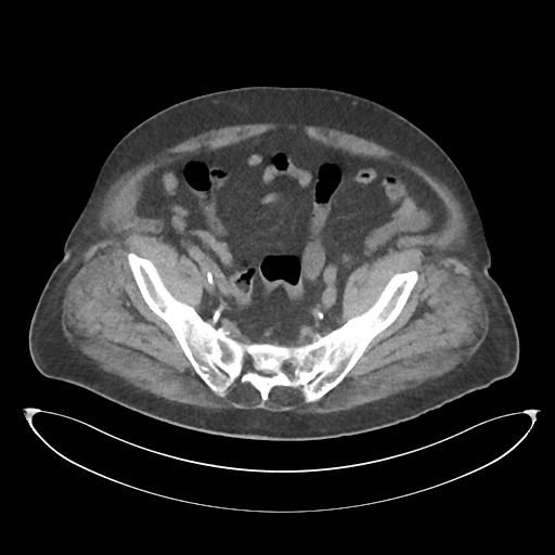 File:Obstructive pyelonephritis (Radiopaedia 46411-50844 Axial non-contrast 63).png