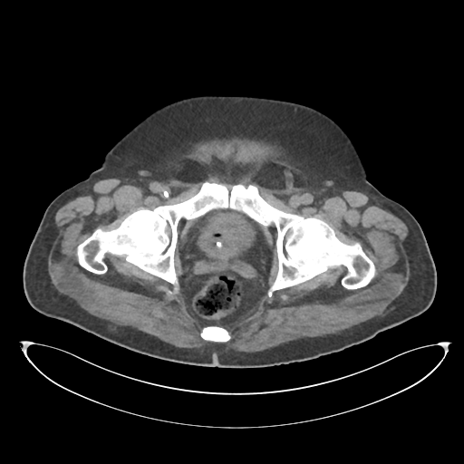 File:Obstructive pyelonephritis (Radiopaedia 46411-50844 Axial non-contrast 75).png