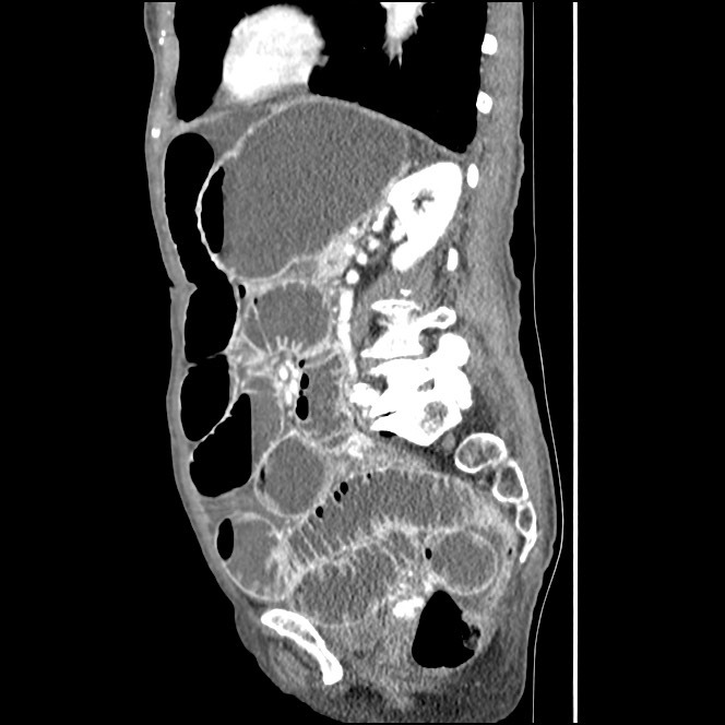 Obturator hernia causing small bowel obstruction (Radiopaedia 65522-74612 C 37).jpg