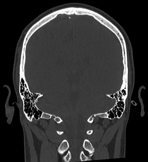 Occipital spur and Currarino type A atlas anomaly (Radiopaedia 87027-103285 Coronal bone window 101).jpg