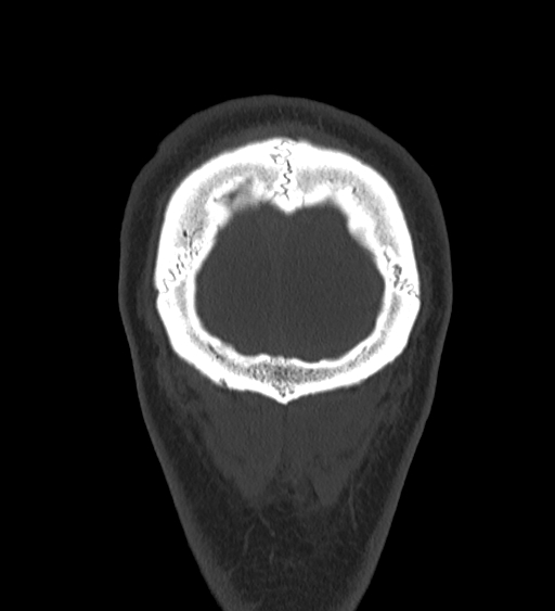 Occipital spur and Currarino type A atlas anomaly (Radiopaedia 87027-103285 Coronal bone window 136).jpg