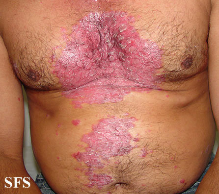 File:Psoriasis (Dermatology Atlas 23).jpg