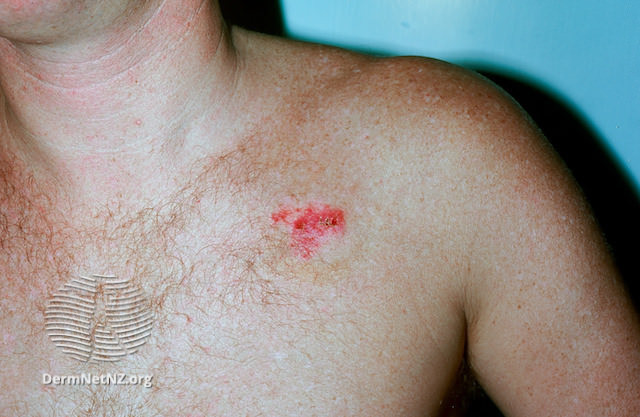 Filesuperficial Basal Cell Carcinoma Chest Dermnet Nz Superficial Basal Cell Carcinoma 4