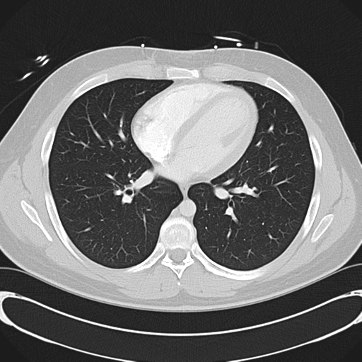 File:'Bovine' aortic arch (Radiopaedia 33554-34637 Axial lung window 37).png