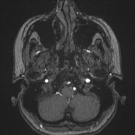 A1 segment hypoplasia (Radiopaedia 83365-97781 Axial TOF MRA 5).jpg