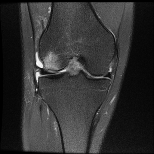 File:ACL acute full thickness tear - deep lateral femoral sulcus sign (Radiopaedia 38594-40740 Coronal PD fat sat 11).jpg