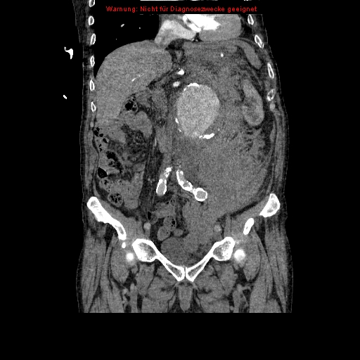 Abdominal aortic aneurysm- extremely large, ruptured (Radiopaedia 19882-19921 Coronal C+ arterial phase 49).jpg