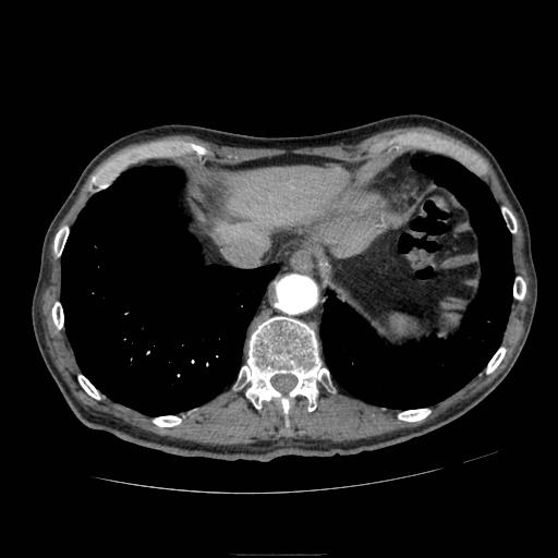 Abdominal aortic aneurysm (Radiopaedia 13341-13340 Axial C+ arterial phase 14).jpg