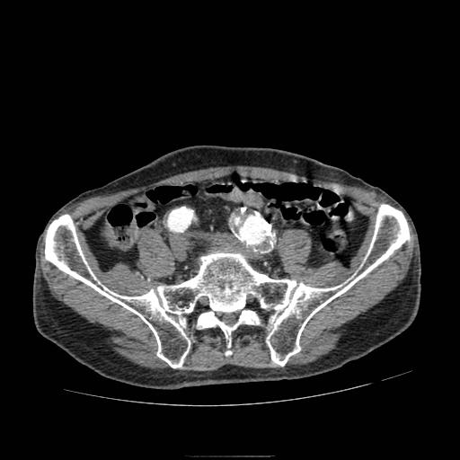 Abdominal aortic aneurysm (Radiopaedia 13341-13340 Axial C+ arterial phase 174).jpg
