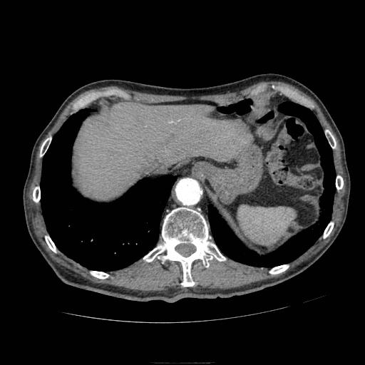 File:Abdominal aortic aneurysm (Radiopaedia 13341-13340 Axial C+ arterial phase 22).jpg