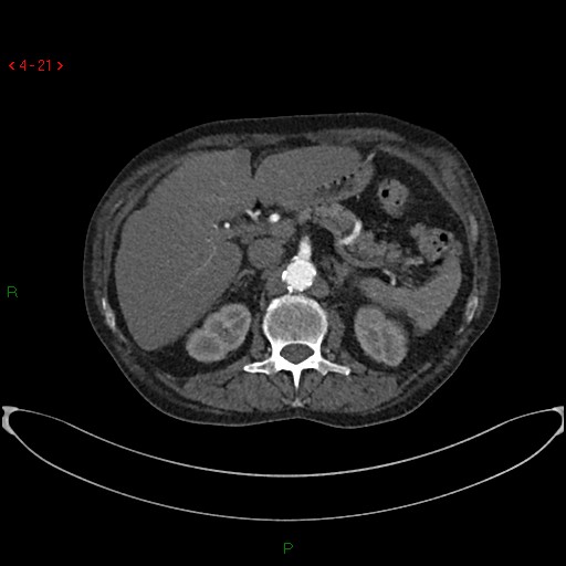 File:Abdominal aortic aneurysm (Radiopaedia 16155-15834 Axial C+ arterial phase 1).jpg