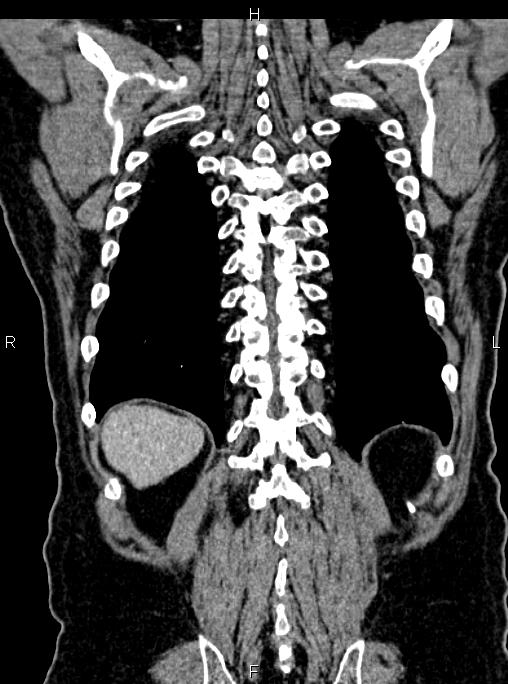 Abdominal aortic aneurysm (Radiopaedia 83094-97462 Coronal renal cortical phase 77).jpg