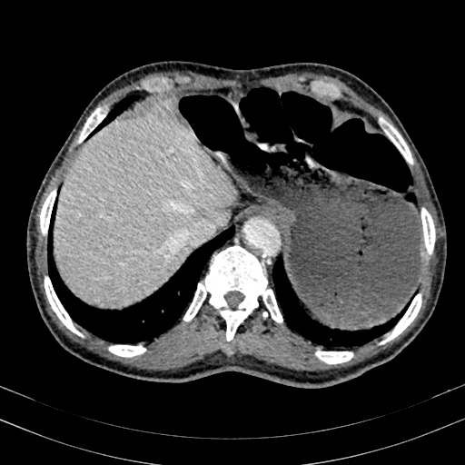 Abdominal aortic aneurysm (Radiopaedia 83581-98689 Axial C+ portal venous phase 17).jpg