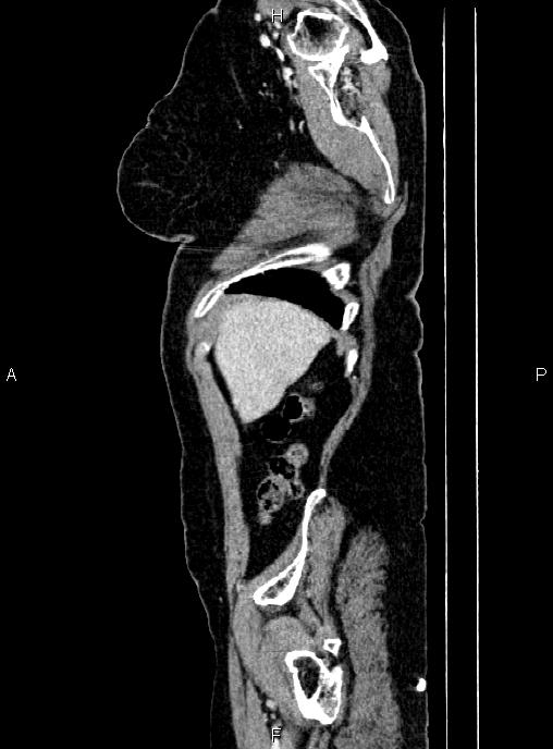 Abdominal aortic aneurysm (Radiopaedia 85063-100606 Sagittal C+ arterial phase 6).jpg