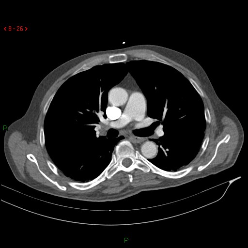 Abdominal aortic aneurysm rupture with aortocaval fistula (Radiopaedia 14897-14841 Axial C+ arterial phase 26).jpg