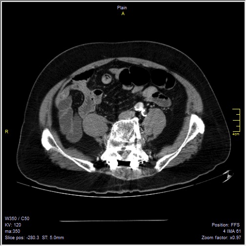 Abdominal aortic aneurysm with thrombus fissuration (Radiopaedia 47340-51926 Axial C+ arterial phase 45).jpg
