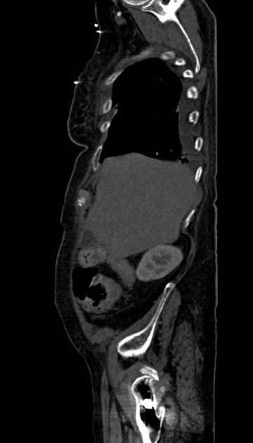Abdominal aortic aneurysm with thrombus fissuration (Radiopaedia 73192-83919 Sagittal C+ arterial phase 120).jpg