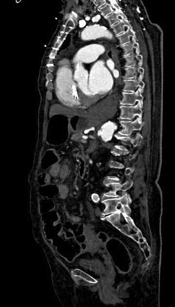 Abdominal aortic aneurysm with thrombus fissuration (Radiopaedia 73192-83919 Sagittal C+ arterial phase 59).jpg