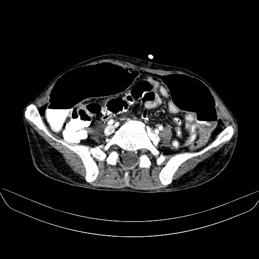 File:Abdominal collection due to previous cecal perforation (Radiopaedia 80831-94320 Axial C+ portal venous phase 139).jpg