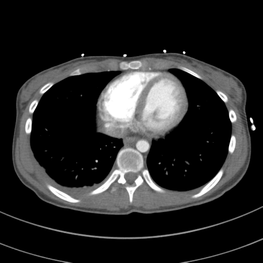 File:Abdominal multi-trauma - devascularised kidney and liver, spleen and pancreatic lacerations (Radiopaedia 34984-36486 Axial C+ arterial phase 61).png